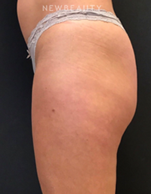 Dr. Janet Allenby - EmSculpt - Before