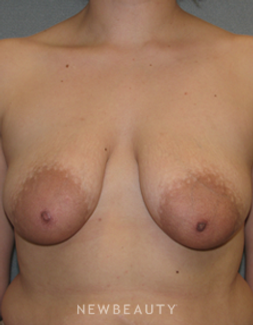 Dr. Sean Simon Breast Augmentation, Breast Lift - Before