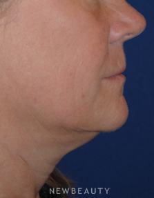Dr. Lee Ann Klausner Ulthera Skin Tightener - Before
