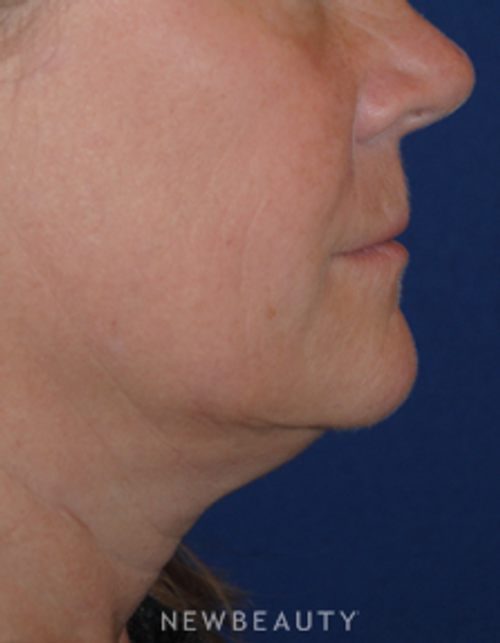 Dr. Lee Ann Klausner Ulthera Skin Tightener - Before