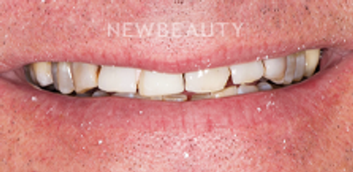 Dr. Salvator La Mastra - Smile Makeover -46107772 - Before