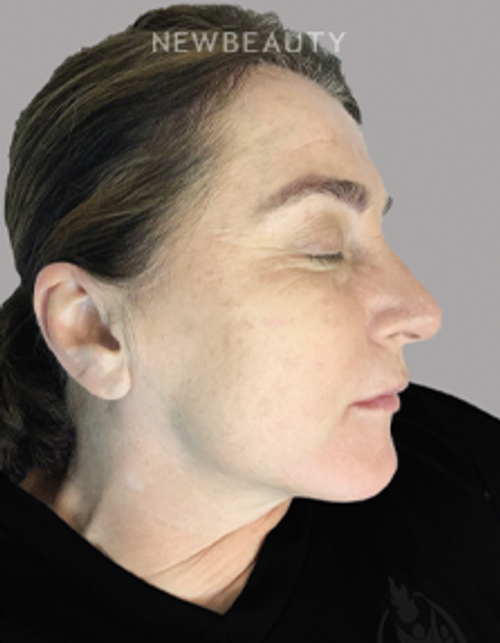 Drs. Elias - Age Spot Remover - 21781149 - After