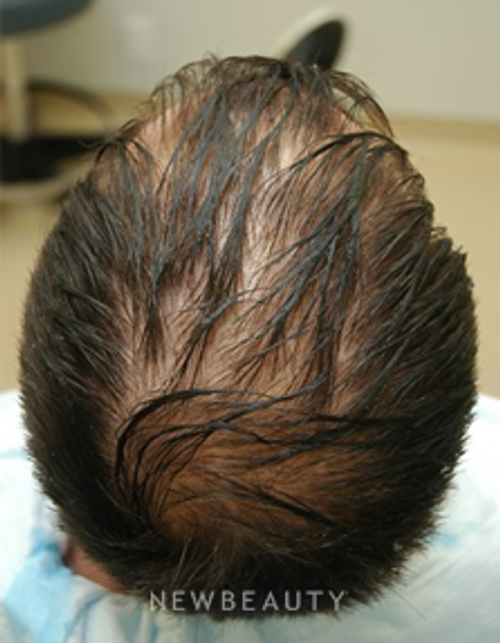 Dr. Jeffrey Rapaport - Hair Transplant - Before