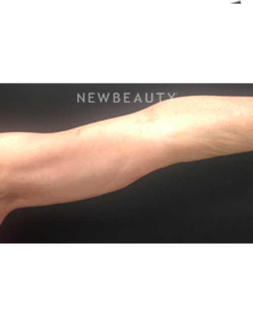Dr. Mokhtar Asaadi - Arm Lift - After