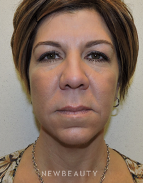 Dr. Joel Schlessinger - Liquid Rejuvenation - After