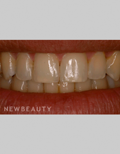 Dr. Bob Perkins Veneers, Orthodontics - After