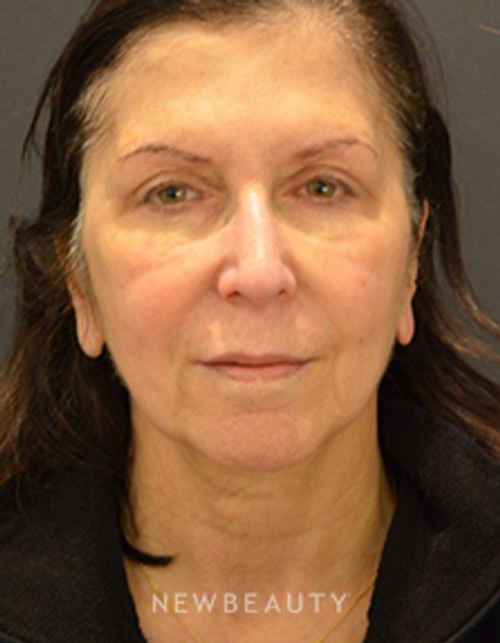 Dr. B. Aviva Preminger - Chemical Peel & Injectables - Before