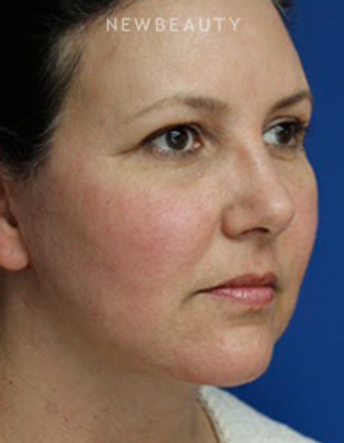 Dr. Joseph Russo - Addressing Facial Aging (Face EBG) - After