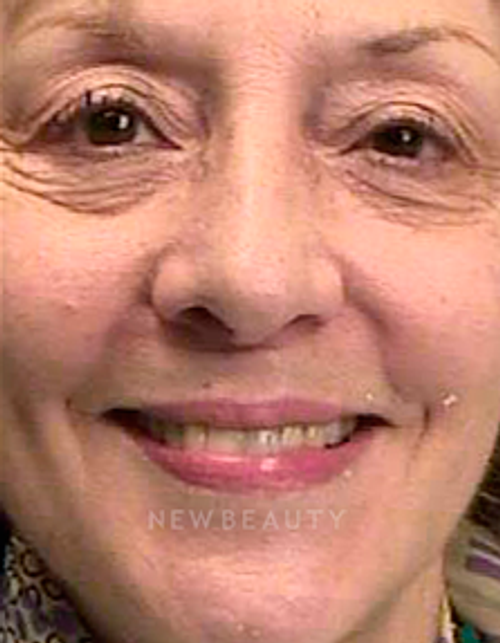 Dr. Irene Grafman Teeth Whitening - Before