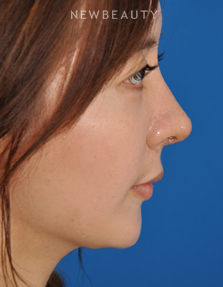 Dr. Edward Kwak - Revision Rhinoplasty - After