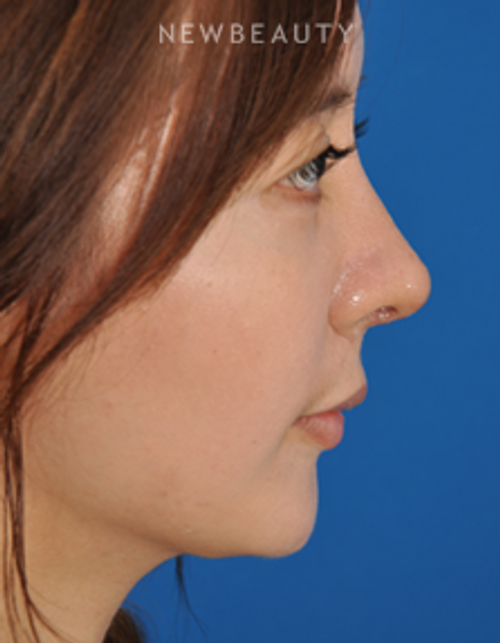 Dr. Edward Kwak - Revision Rhinoplasty - After