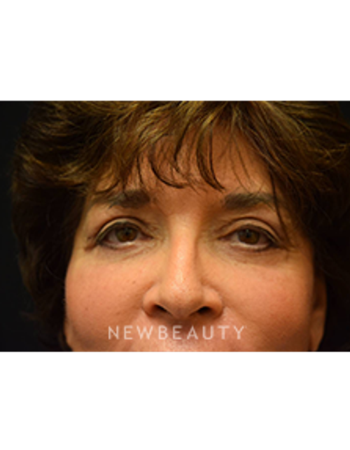 Dr. Jeffrey B. Wise - Eyelift, Facelift & Lasers - After