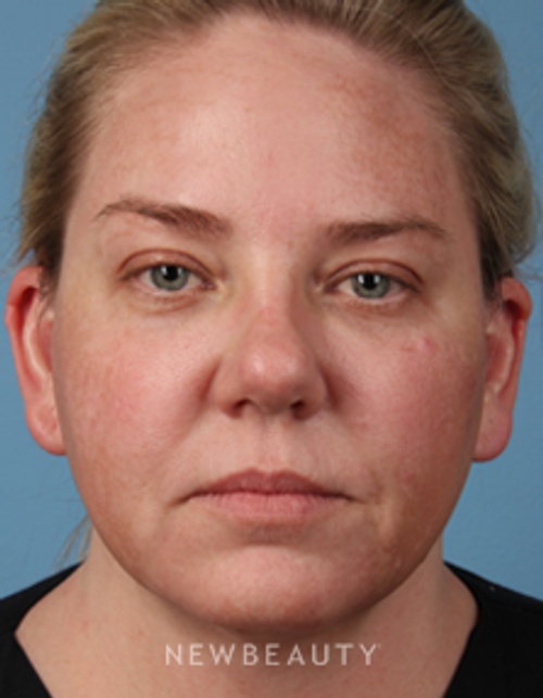 Dr. Kathleen Behr - Natural-Looking Facial Rejuvenation - Before