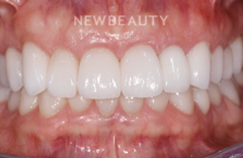 Dr. Sara Cummins - Smile Makeover - 14738160 - After