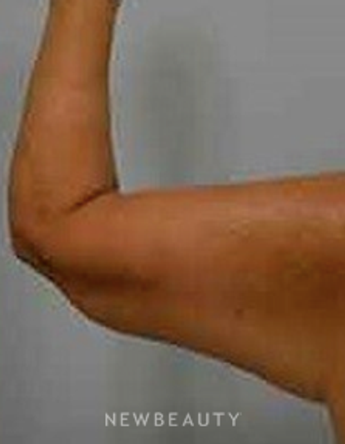Dr. Aviva Preminger - Arm Lift - After