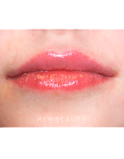 Dr. Marina Peredo Lip Augmentation - After