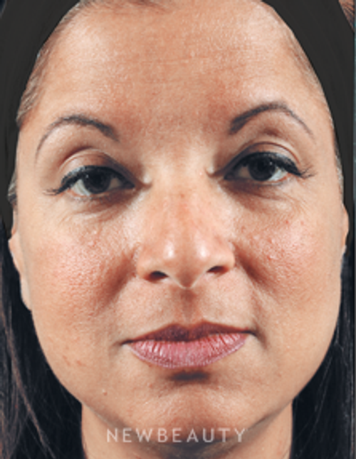 Dr. Marina Peredo Injectables & Fillers - Before