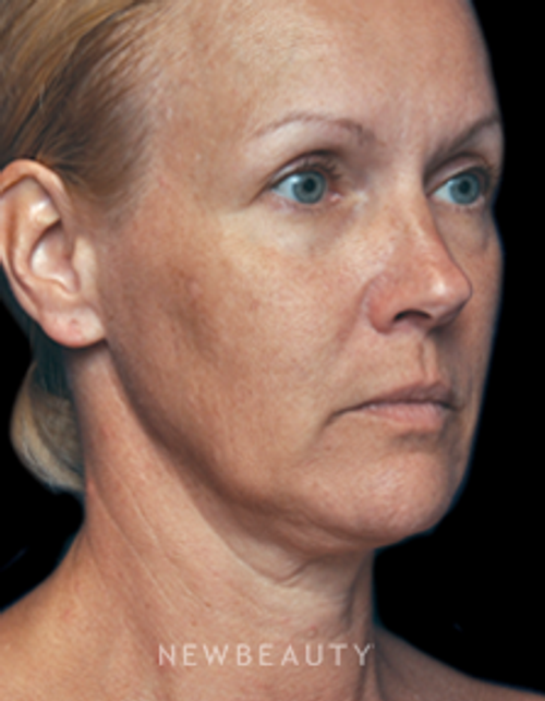 Dr. Alan J. Durkin - Facial Rejuvenation - Before