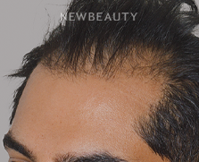 Dr. Anthony Bared - Hair Transplant - 46164563 - Before
