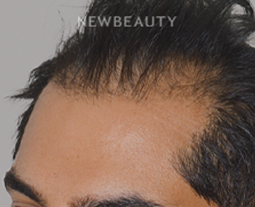 Dr. Anthony Bared - Hair Transplant - 46164563 - Before