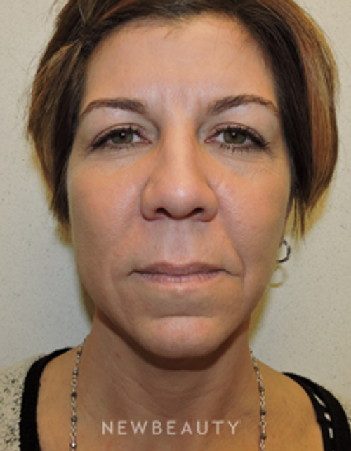 Dr. Joel Schlessinger - Liquid Rejuvenation - Before