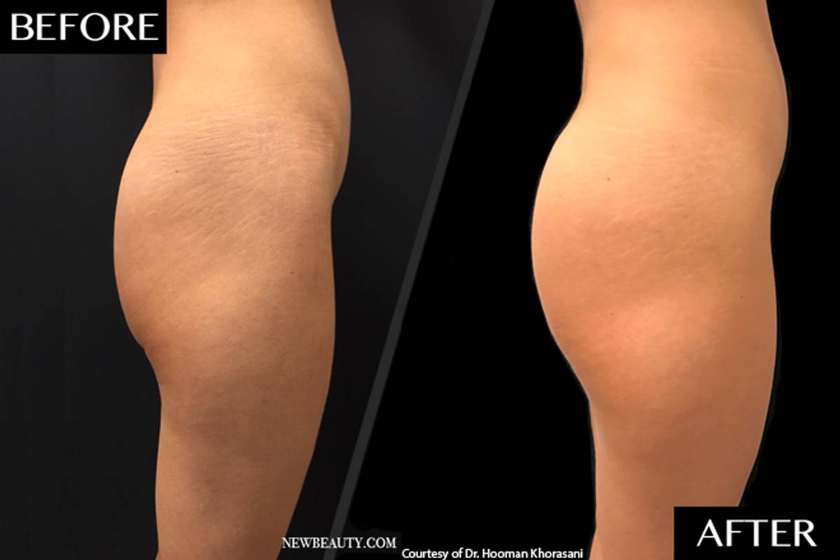sculptra butt lift