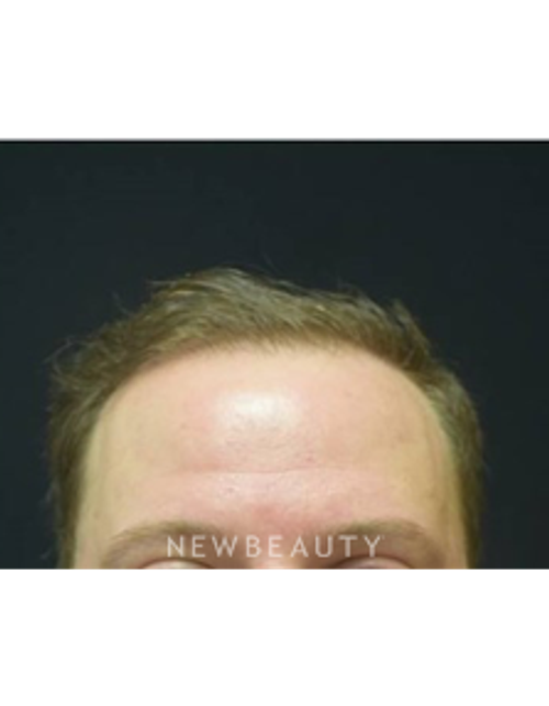 Dr. Jeffrey B. Wise - Hair Transplant - After
