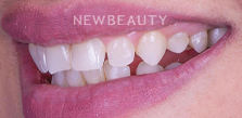 Dr. Husam Almunajed - Gum Lift & Veneers - 32922683 - Before