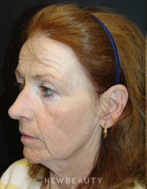 Dr. Mokhtar Asaadi Eyelid Lift, Facelift, Necklift - Before