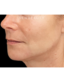 Dr. Janet Allenby - Liquid Facelift - After
