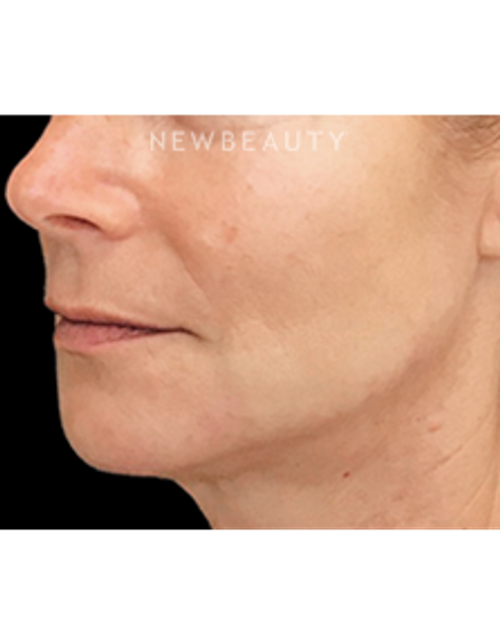 Dr. Janet Allenby - Liquid Facelift - After