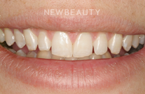 Dr. Joe Kravitz - Veneers - 14082675 - Before