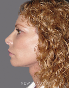 Dr. Andrew Ordon Facelift, Necklift, Chemical Peel, Injectables & Fillers, Lasers - After