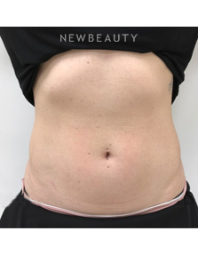 Dr. Julie Russak - Fat Reduction - After
