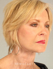 Dr. Mentz - Eyelift, Facelift, Necklift - After