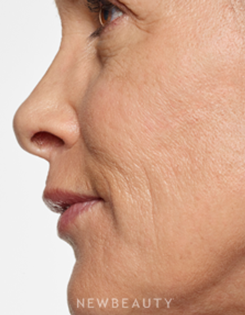 Dr. Marina Peredo - Lip Enhancement - After