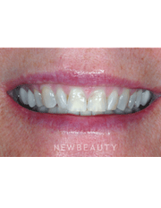 Dr. Guy M. Lewis, Smile Makeover - Before