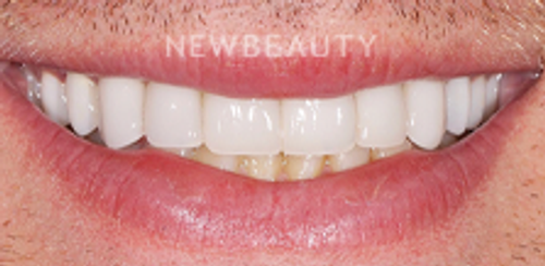 Dr. Salvator La Mastra – Smile Makeover – 46107075 - After