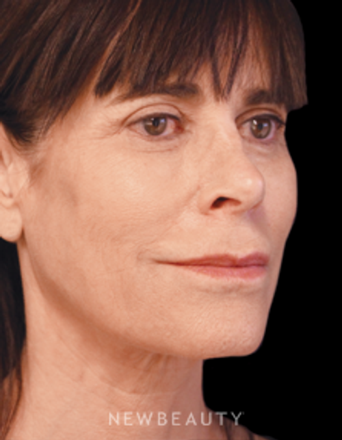 Dr. Joseph A. Russo - FaceTite - After