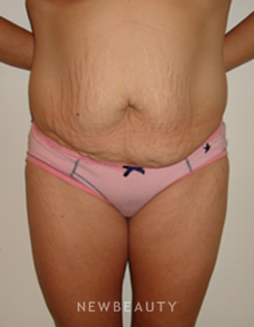 Dr. Michael Horn Tummy Tuck - Before