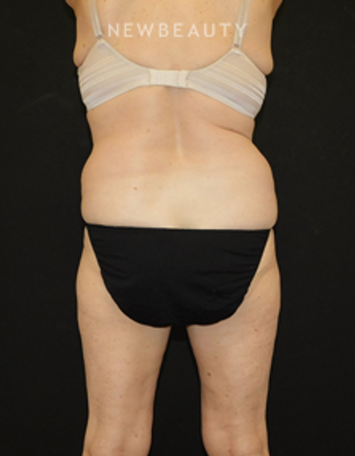 Dr. Joel Schlessinger - Smart Lipo - Before