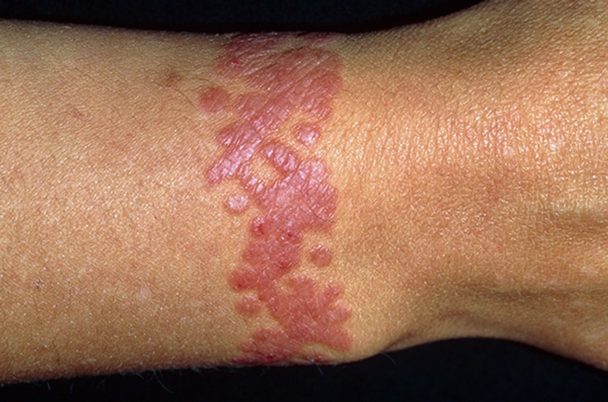 Rash. Close-up of a 39 year old woman's wrist showing a rash at the site of a tattoo. Tattoos are designs made on the skin by introducing permanent dyes into the skin layers. Here, an allergy to a part of the process caused the rash, an area of raised and reddened skin. Tattooing safely requires sterile conditions, as there is a risk of transmitting hepatitis or AIDS (acquired immune deficiency syndrome) through the needles used. Rashes can be treated with soothing skin creams such as calamine lotion, or antihistamine drugs to reduce the inflammation and itching.