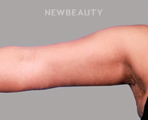 Dr. Peter Vonu - Sleeker Arms - After