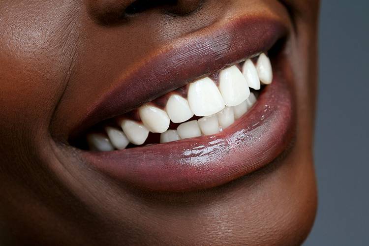 veneersbonding