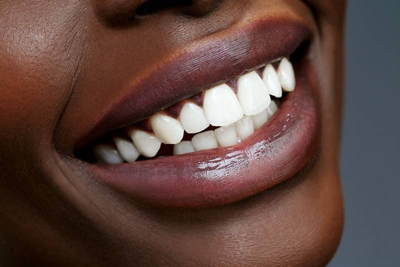 veneersbonding