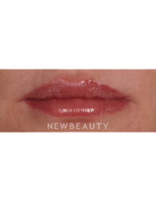 Dr. Kelly Bomer, Lip Enhancement - After