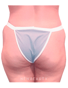 Dr. Henry Mentz Liposuction, Tummy Tuck - Before