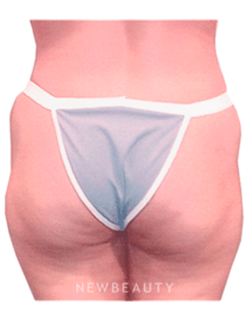 Dr. Henry Mentz Liposuction, Tummy Tuck - Before