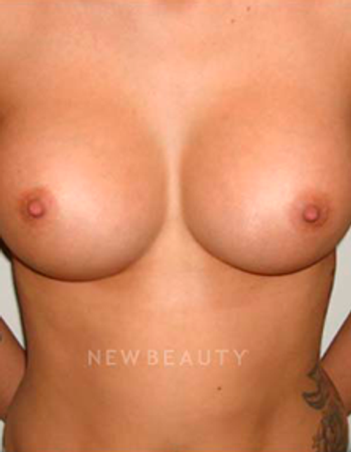 Dr. Michael Horn Silicone Breast Implants - After