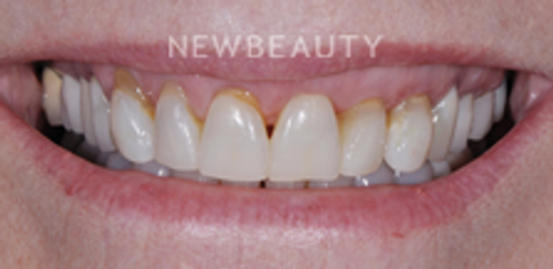 Dr. Salvator La Mastra - Smile Makeover -46107993 - Before